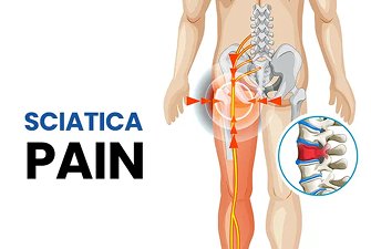 Sciatica Treatment