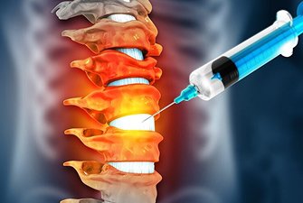 Cervical Epidural Steroid Injection