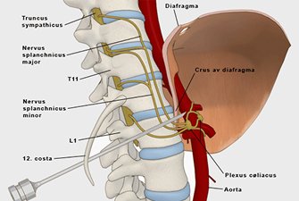 Coeliac Plexus Block