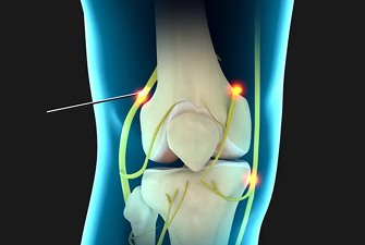 Genicular Radiofrequency Ablation