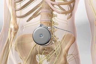 Intrathecal Pain Pump