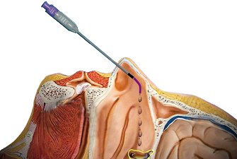 Sphenopalatine Ganglion Block