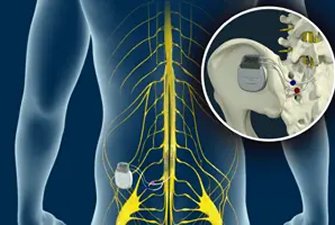 Spinal Cord Stimulator