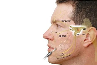 Trigeminal Radiofrequency Ablation