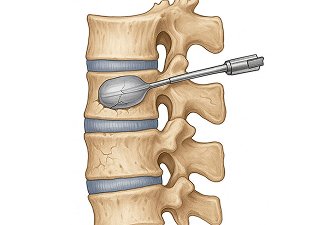 Vertebroplasty and Kyphoplasty
